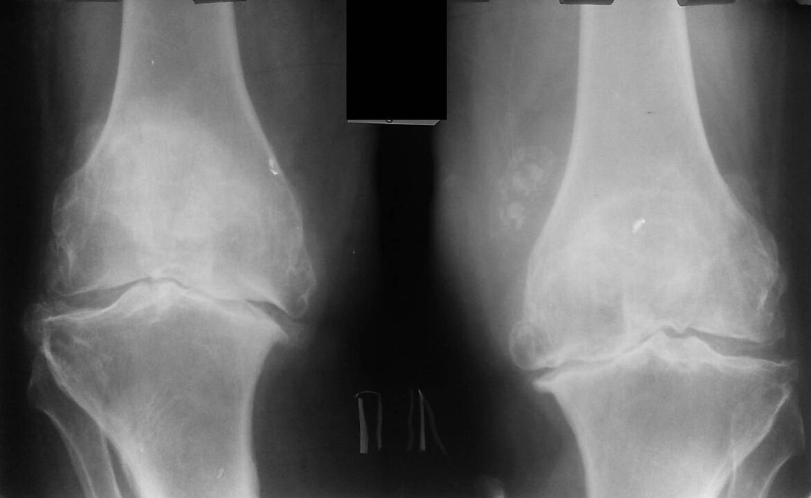 artrosia duten belauneko artikulazioen erradiografia