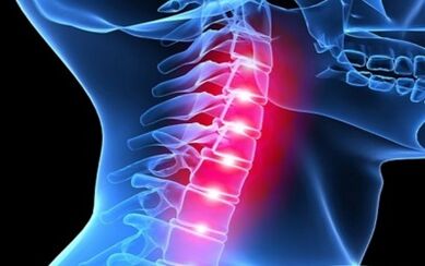 Bizkarrezurreko bizkarrezurraren osteochondrosisaren sintomak