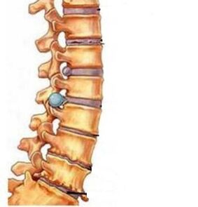 Cervical eskualdearen osteochondrosia nola garatzen den
