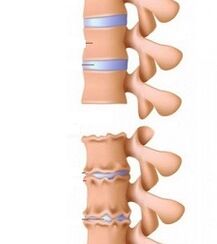 Lepoaren osteokondrosiaren arrapalak