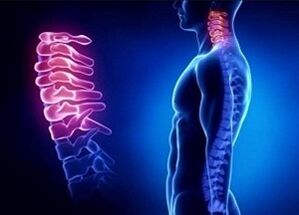 Osteokonondrosaren cervikala garatzeko arrazoiak