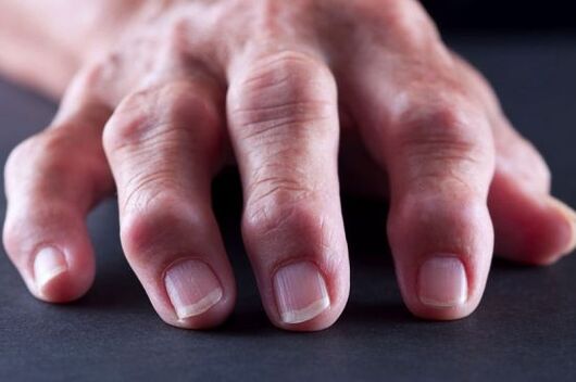 Artrosiaren edo artritisaren ondorioz hatzen deformazio artikularrak